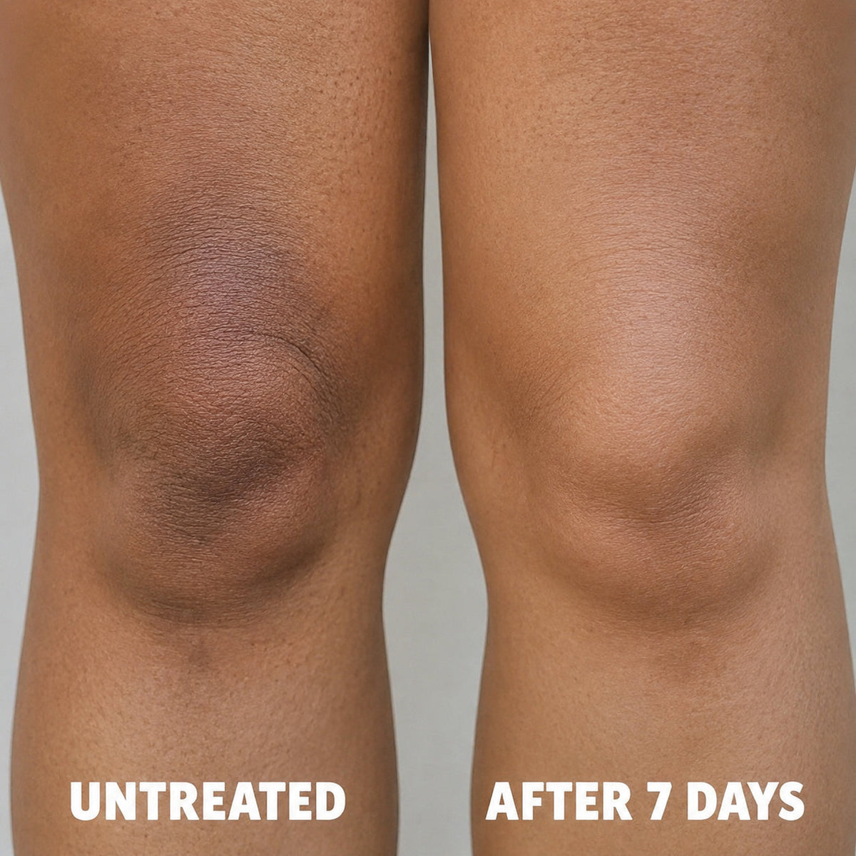 Cellular-Level Delivery Triple Acid Complex For Hyperpigmentation