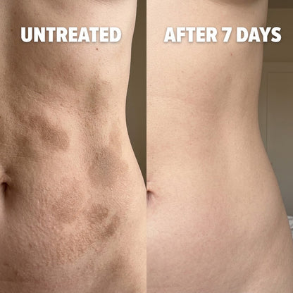 Cellular-Level Delivery Triple Acid Complex For Hyperpigmentation