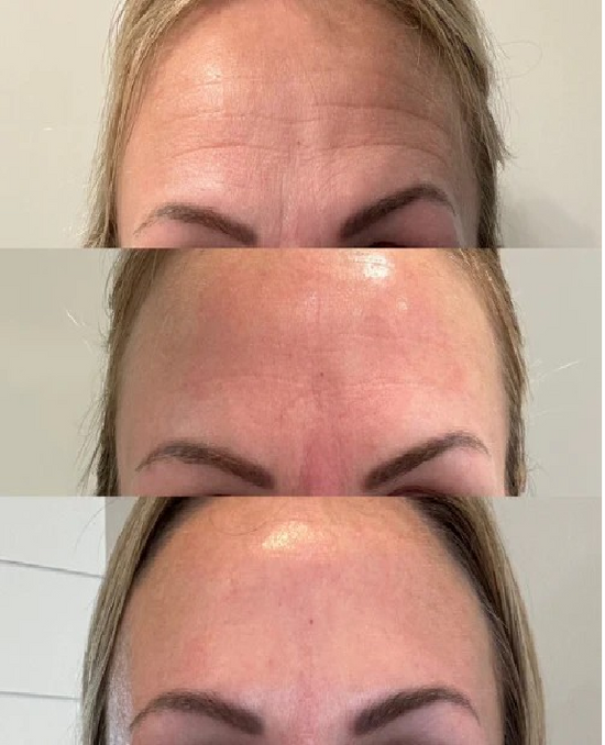 3_forehead_b4_n_after.png