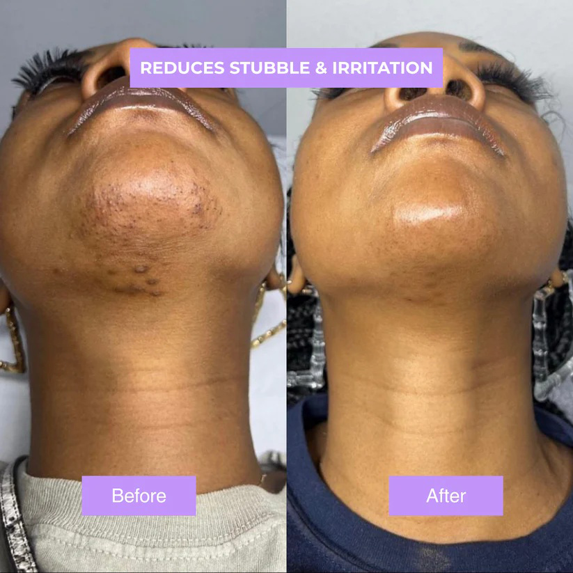 roshang™ - Cyperus Rotundus Skin Serum