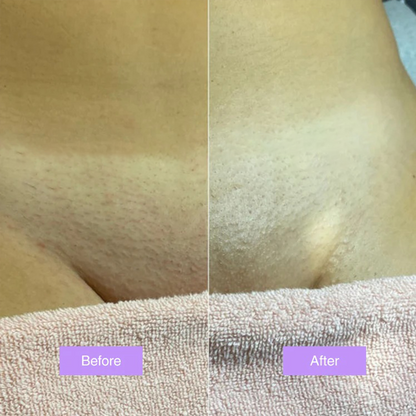 roshang™ - Cyperus Rotundus Skin Serum